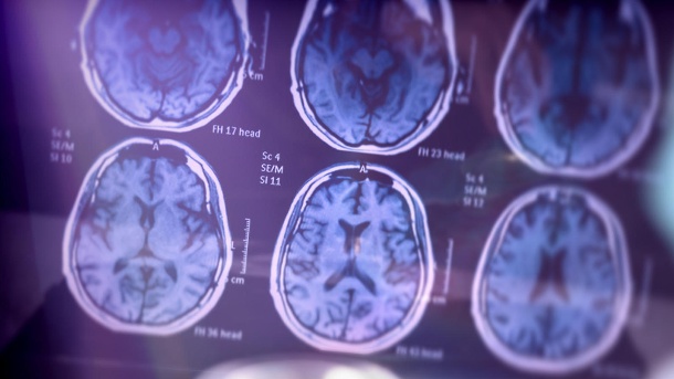 Gehirn-Scan: Neuere Studien und Fallberichte beschreiben zunehmend die Auswirkungen von Covid-19 auf das Gehirn.  (Quelle: Getty Images / Digicomphoto)