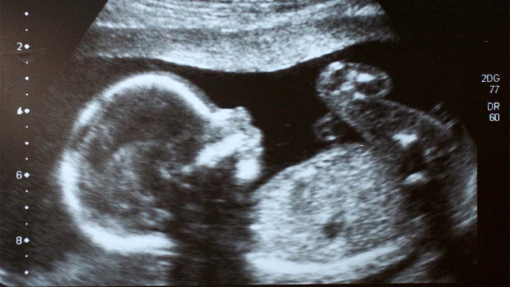 Baby mit Zwilling im Bauch in extremer medizinischer Seltenheit geboren: Bericht